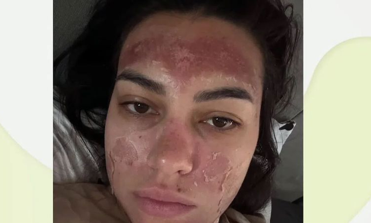 „Билков“ пилинг обезобрази млада майка: Изгаряне втора степен и дълго възстановяване