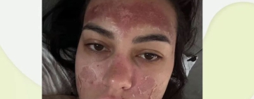 „Билков“ пилинг обезобрази млада майка: Изгаряне втора степен и дълго възстановяване